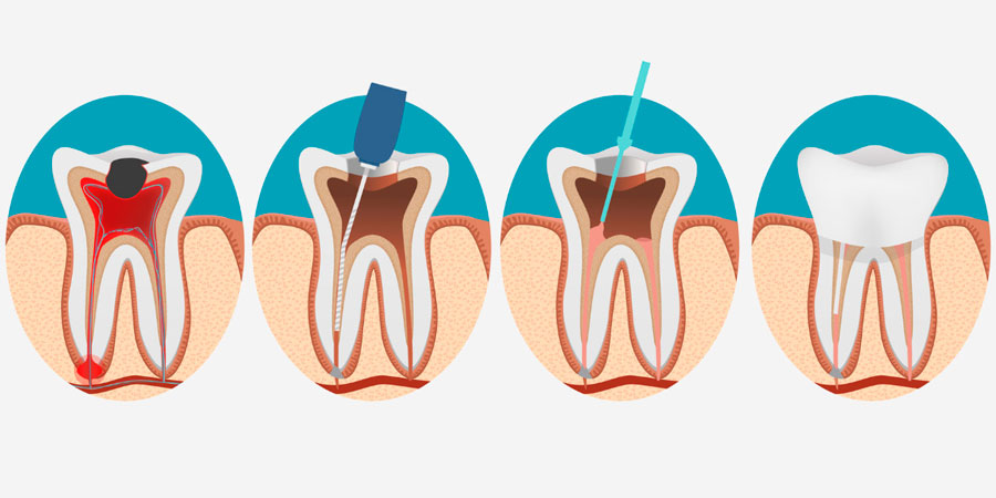 endodoncia en alicante